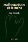MALFORMACIONES DE LA MANO de SOLA, MINGUELLA 