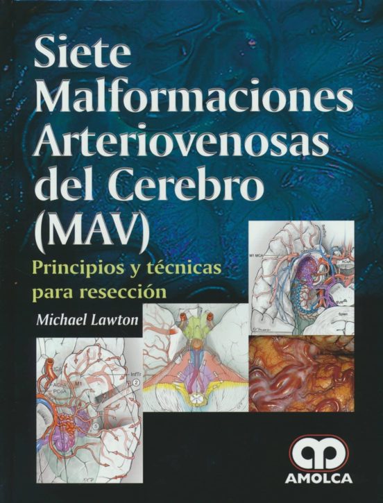 Siete Malformaciones Arteriovenosas Del Cerebro