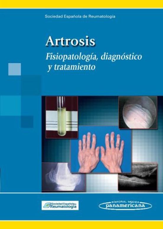 Artrosis: Fisiopatologia Diagnostico Y Tratamiento