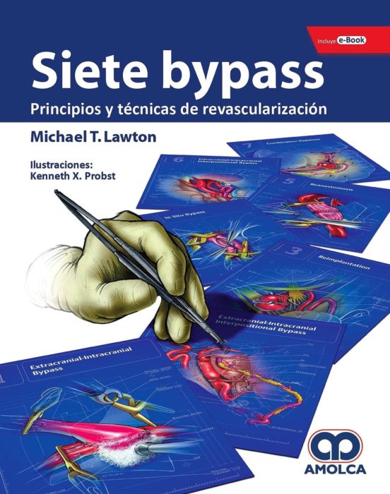 Siete Bypass: Principios Y Tecnicas De Revascularizacion + E-book