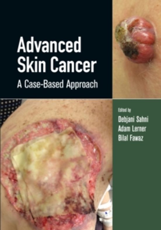 Advanced Skin Cancer