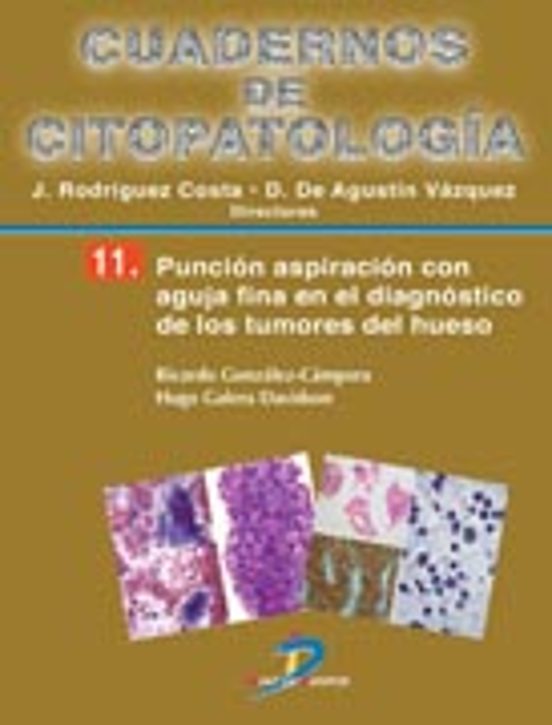 Punción Aspiración Con Aguja Fina En El Diagnóstico De Los Tumores De Hueso
