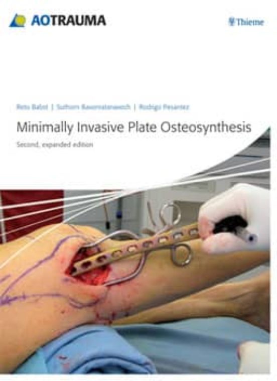 Minimally Invasive Plate Osteosynthesis