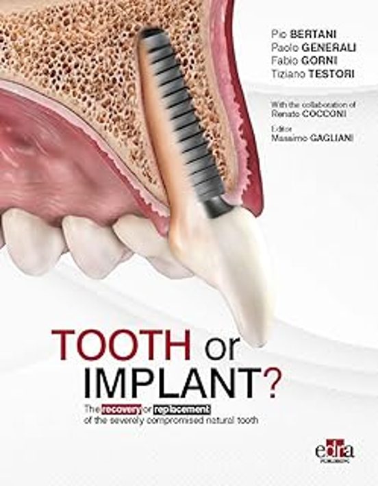 Tooth Or Implant? The Recovery Or Replacement Of The Severely Compromised Natural Tooth