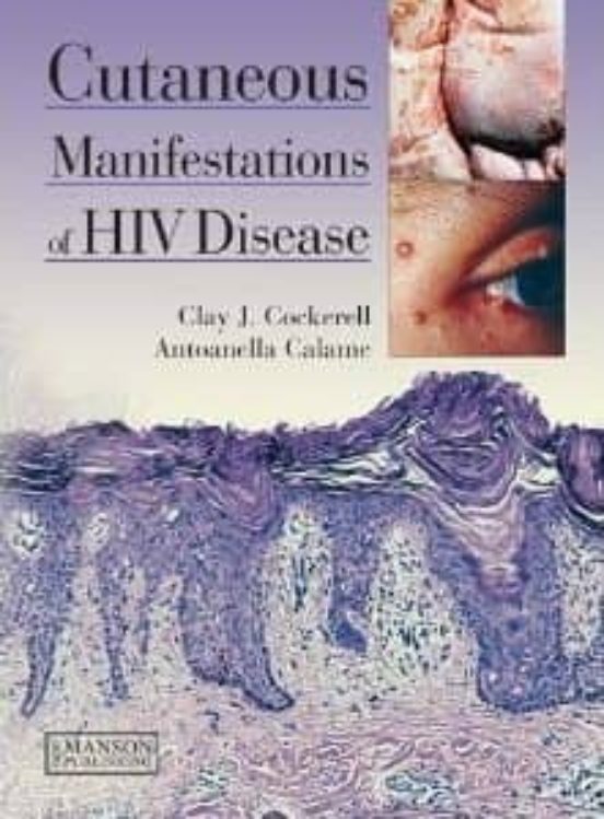 Cutaneous Manifestations Of Hiv Disease