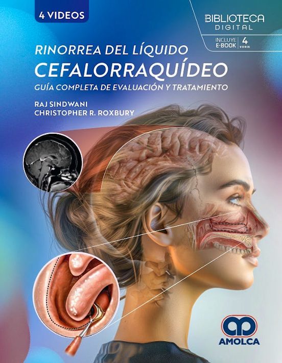 Rinorrea Del Líquido Cefalorraquídeo. Guía Completa De Evaluación Y Tr