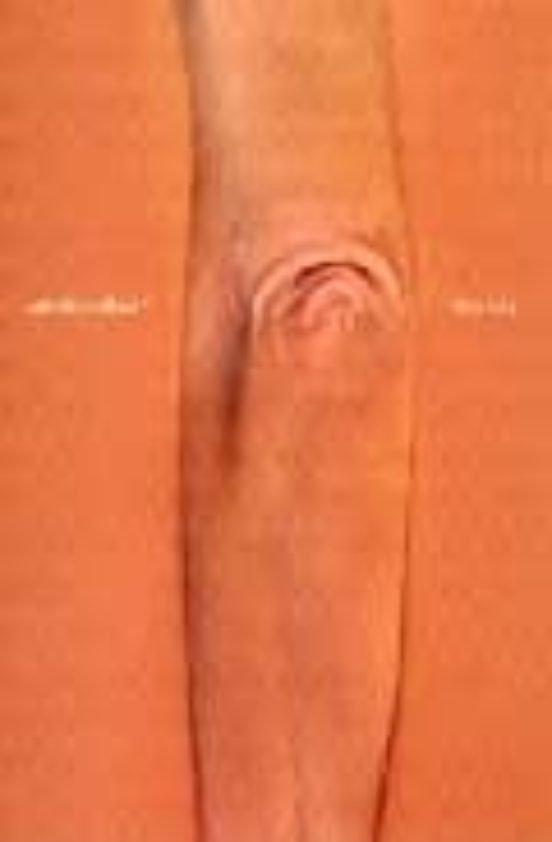 Thin Skin