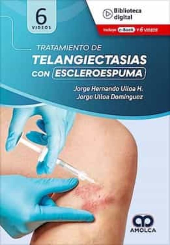 Tratamiento De Telangiectasias Con Escleroespuma
