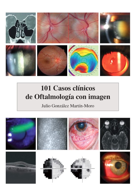 101 Casos Clínicos De Oftalmología Con Imagen