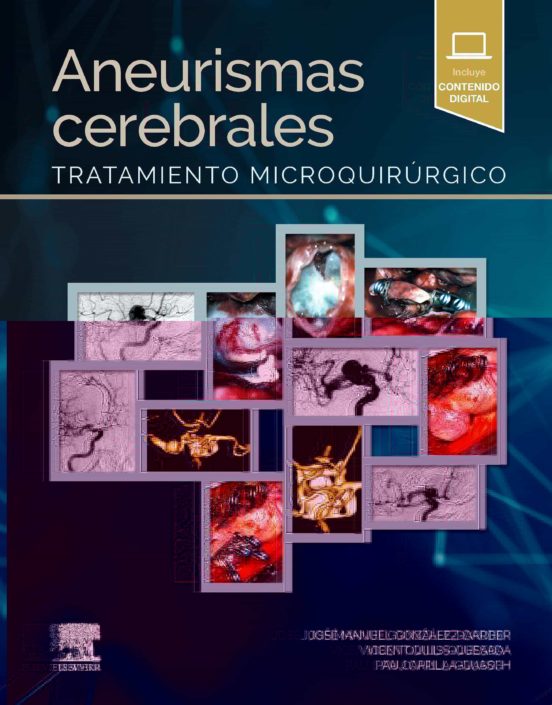Aneurismas Cerebrales