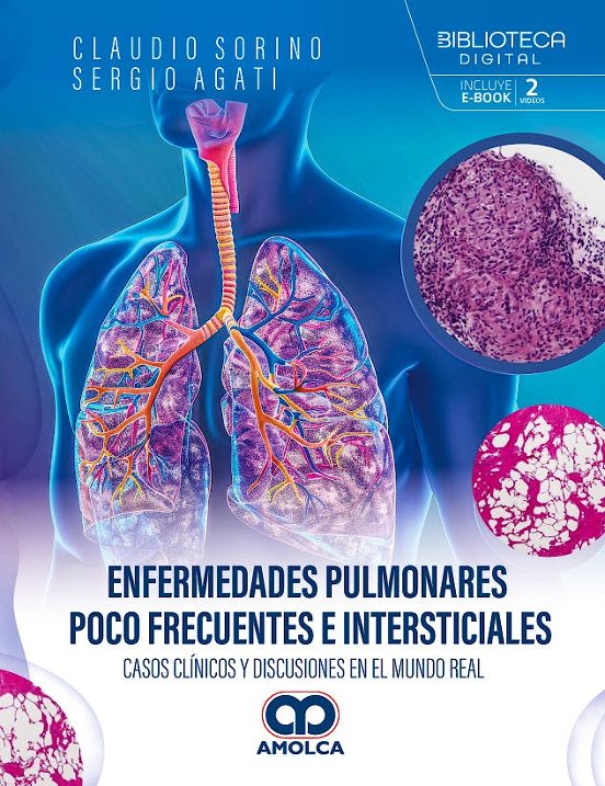 Enfermedades Pulmonares Poco Frecuentes E Intersticiales