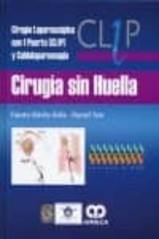 Cirugia Sin Huella: Cirugia Laparoscopica Con 1 Puerto Y C Uldo