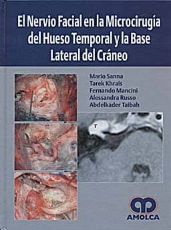 El Nervio Facial En La Microcirugia Del Hueso Temporal Y La Base Later