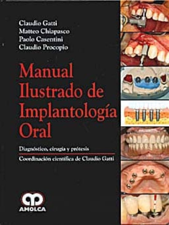 Manual Ilustrado De Implantologia Oral
