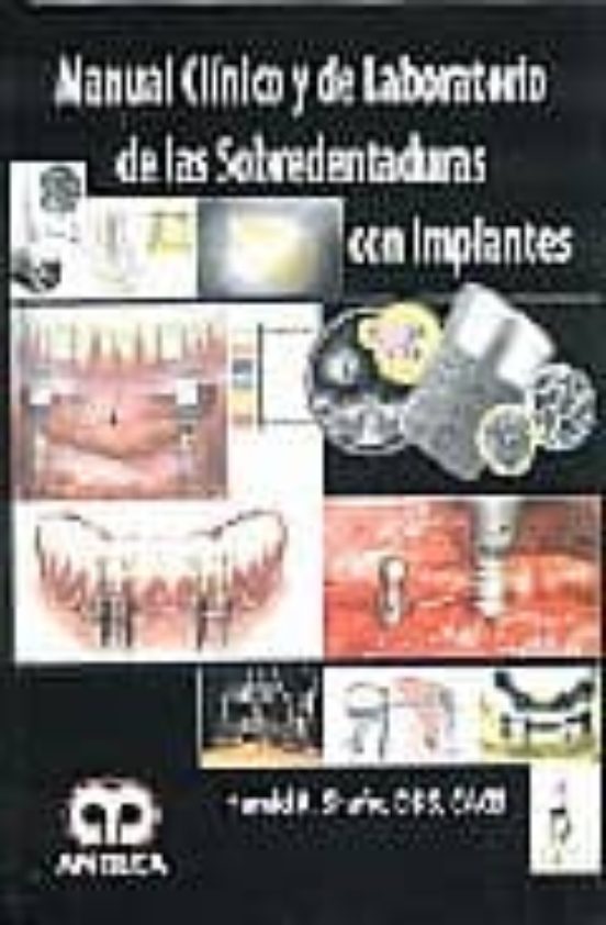 Manual Clinico Y De Laboratorio De Las Sobredentaduras Con Implan Tes
