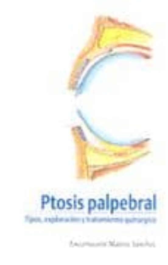 Ptosis Palpebral: Tipos Exploracion Y Tratamiento Quirurgico