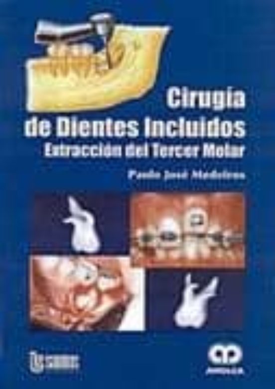 Cirugia De Dientes Incluidos: Extraccion Del Tercer Molar