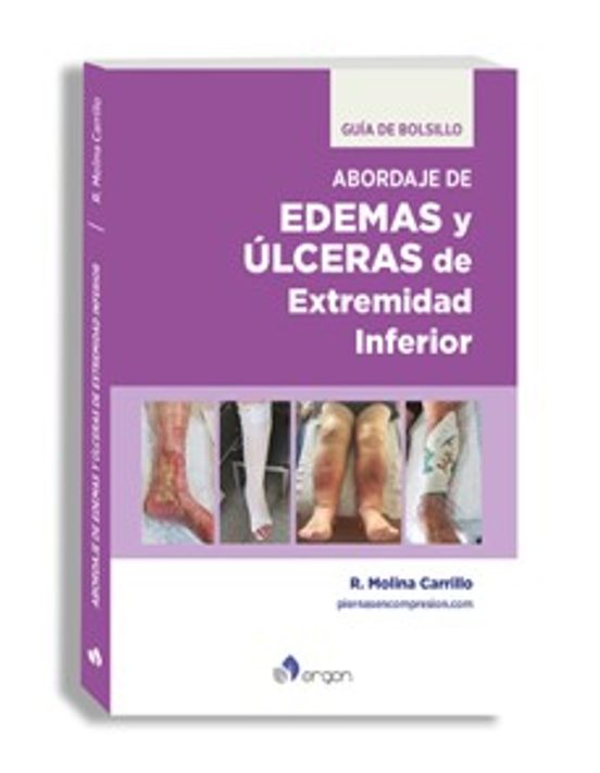 Abordaje De Edemas Y Úlceras De Extremidad Inferior