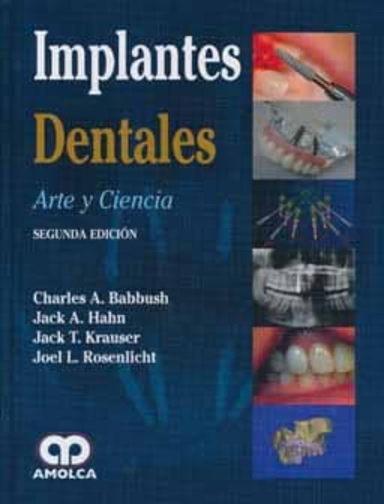 Implantes Dentales: Arte Y Ciencia