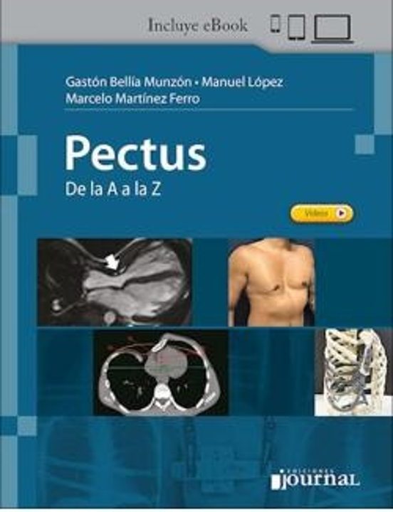 Pectus. De La A A La Z