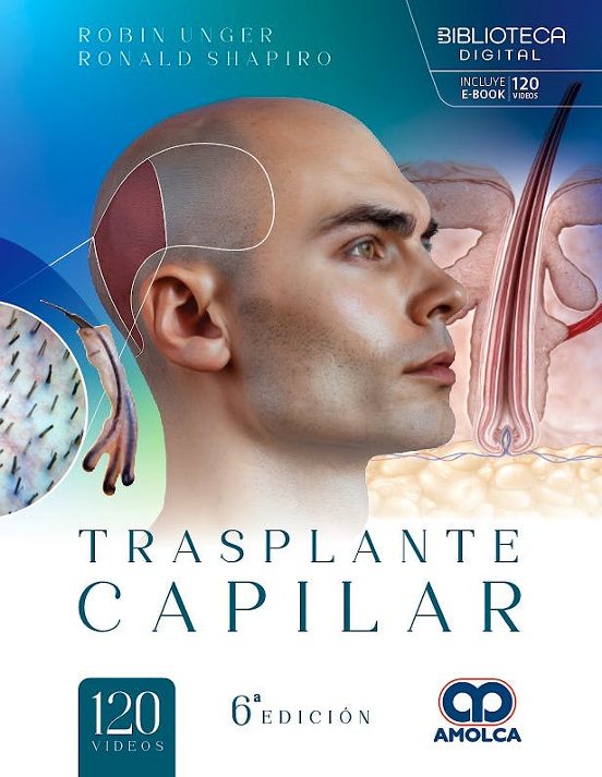 Trasplante Capilar