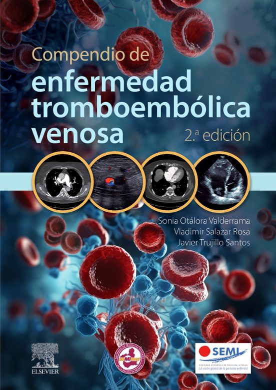 Compendio De Enfermedad Tromboembólica Venosa