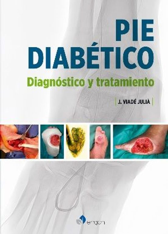 Pié Diabético. Diagnóstico Y Tratamiento