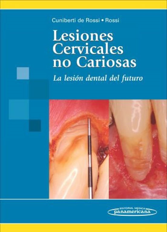 Lesiones Cervicales No Cariosas: La Lesion Dental Del Futuro