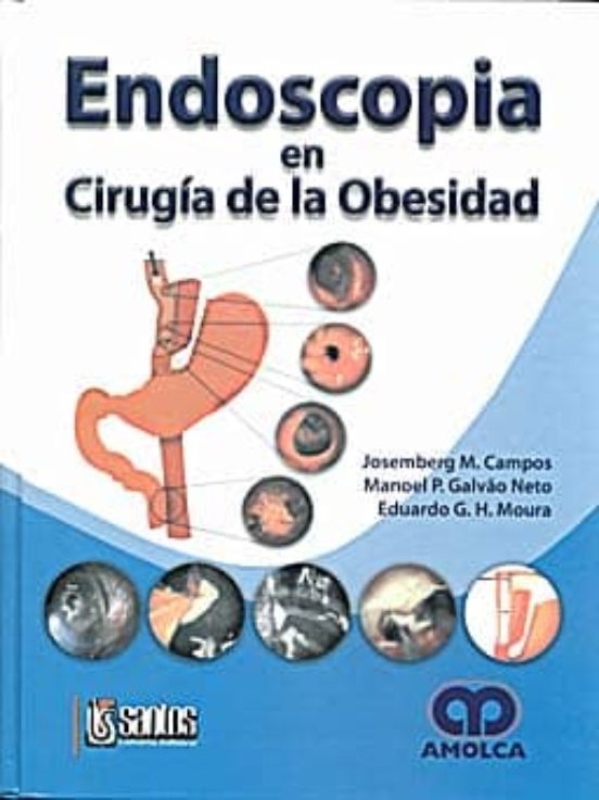 Endoscopia En Cirugia De La Obesidad