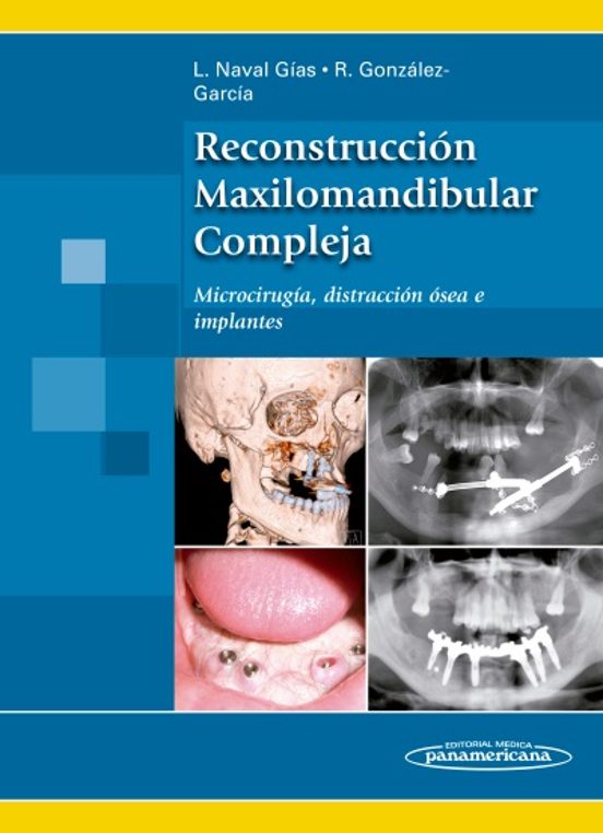 Reconstrucción Maxilomandibular Compleja. Microcirugía Distracción Óse