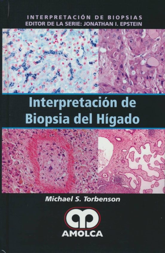 Interpretacion De Biopsia Del Higado