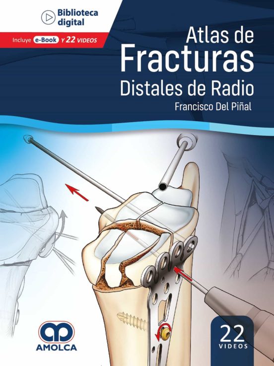 Atlas De Fracturas Distales De Radio