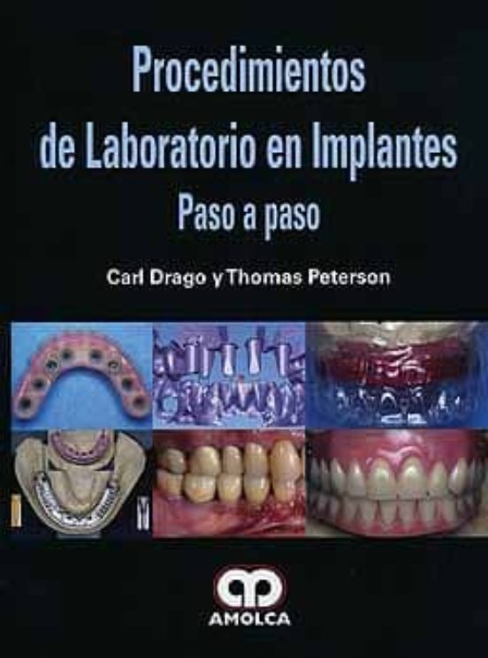 Procedimientos De Laboratorio En Implantes: Paso A Paso
