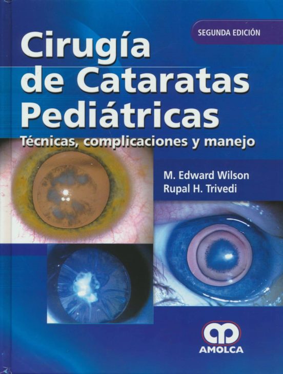 Cirugia De Cataratas Pediatricas