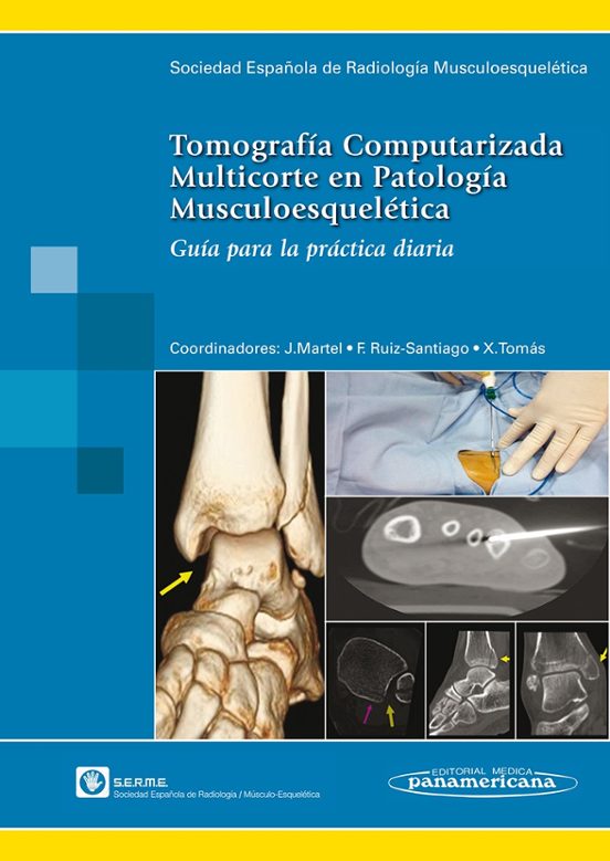 Tomografia Computarizada Multicorte En Patologia Musculoesqueleti Ca