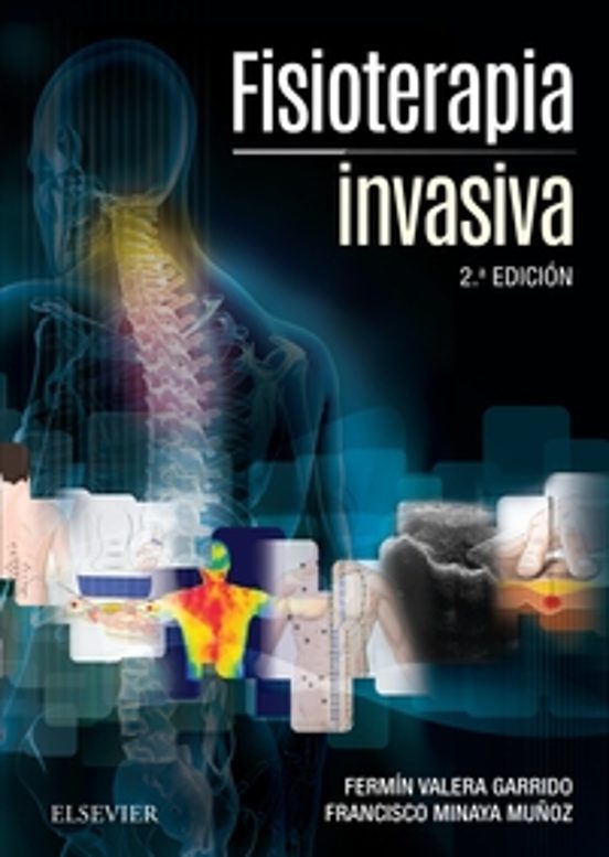 Fisioterapia Invasiva 2ª Ed