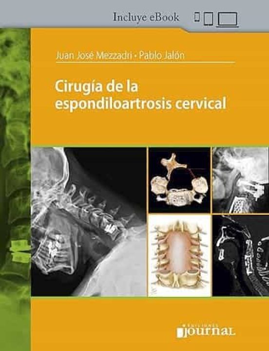 Cirugia De La Espondiloartrosis Cervical